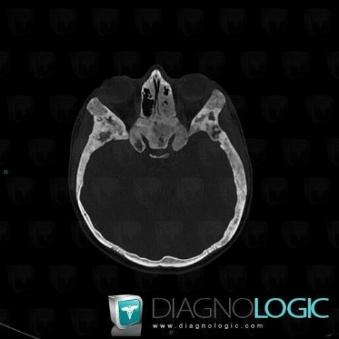 Dysplasie fibreuse, Sinus, Scanner