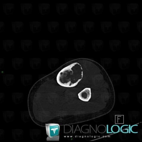Dysplasie fibreuse, Tibia -moyen, Scanner