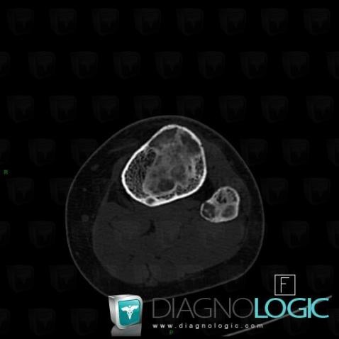Dysplasie fibreuse, Tibia -supérieur, Fibula -supérieur, Scanner