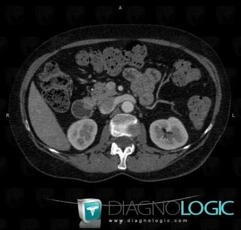 Ectopic pancreas, Pancreas, Duodenum, CT