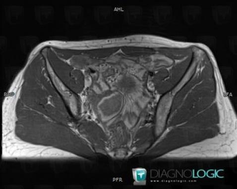 Ectopic pregnancy, Adnexa / Ovary fallopian tube, MRI