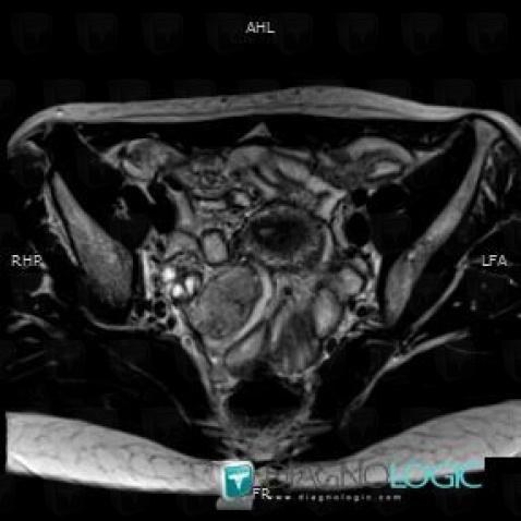 Ectopic pregnancy, Adnexa / Ovary fallopian tube, Pelvis / Perineum, MRI