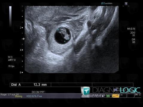 Ectopic pregnancy, Adnexa / Ovary fallopian tube, US