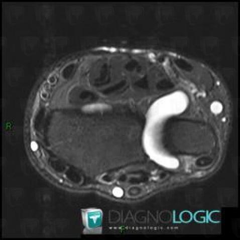 Effusion, Distal radio ulnar joint, MRI