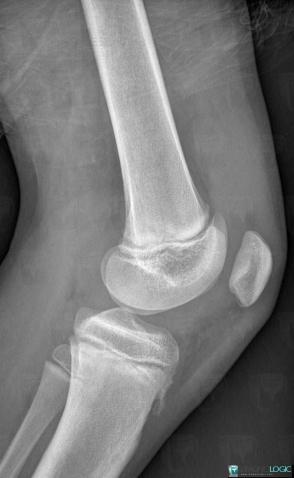 Effusion, Patellofemoral joint, X rays