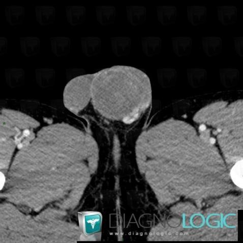 Embryonal cell cancer, Scrotum, CT