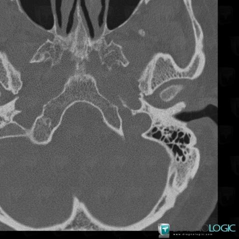 Emissary vein, Skull vault, CT