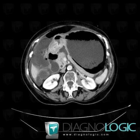 Emphysematous gastritis, Stomach, CT