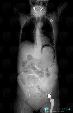 Emphysematous gastritis, Stomach, X rays