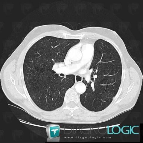 Emphysème centrolobulaire, Parenchyme pulmonaire, Scanner