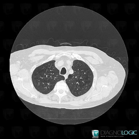 Cas radiologie : Emphysème centrolobulaire (Scanner) - Diagnologic