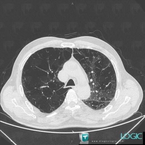 Emphysème centrolobulaire, Parenchyme pulmonaire, Scanner