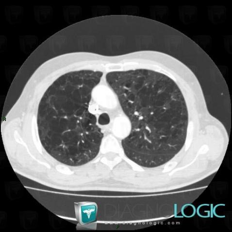 Emphysème centrolobulaire, Parenchyme pulmonaire, Scanner