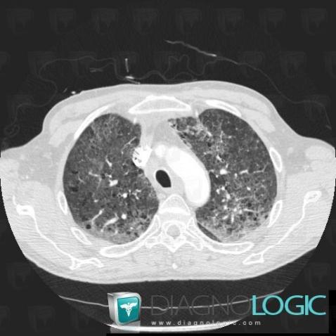 Emphysème centrolobulaire, Parenchyme pulmonaire, Scanner