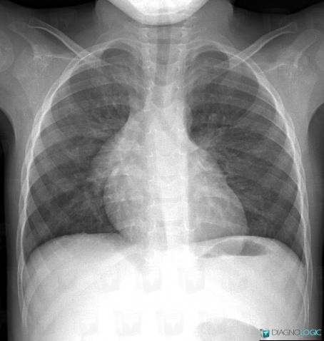 Emphysème lobaire géant, Parenchyme pulmonaire, Radio