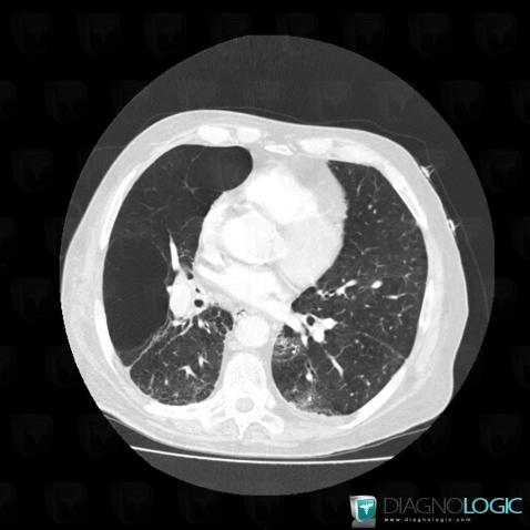 Emphysème lobaire géant, Parenchyme pulmonaire, Scanner