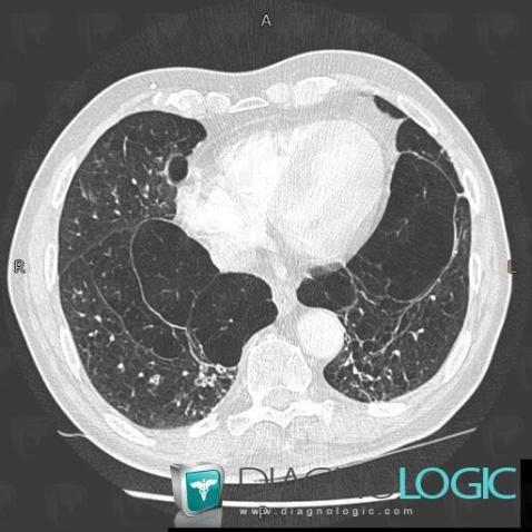 Emphysème panlobulaire, Parenchyme pulmonaire, Scanner