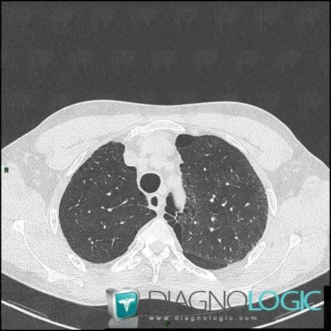 Emphysème paraseptal, Parenchyme pulmonaire, Scanner