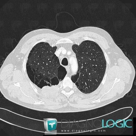 Emphysème paraseptal, Parenchyme pulmonaire, Scanner