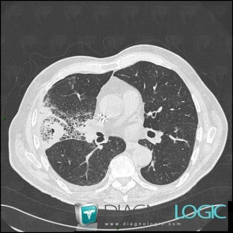 Emphysème, Parenchyme pulmonaire, Scanner