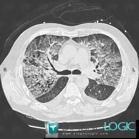 Emphysème, Parenchyme pulmonaire, Scanner