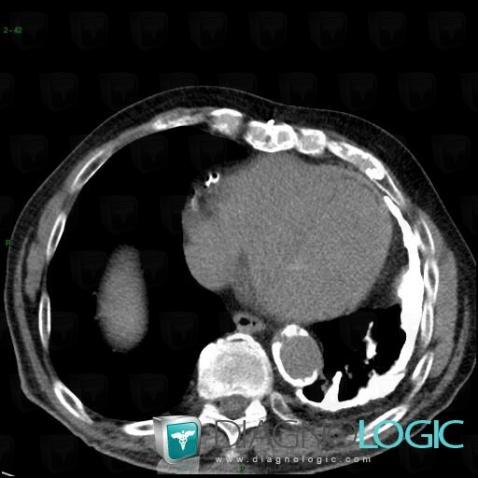 Empyema, Pleura, CT