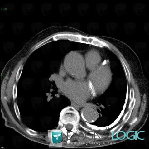 Empyema, Pleura, CT