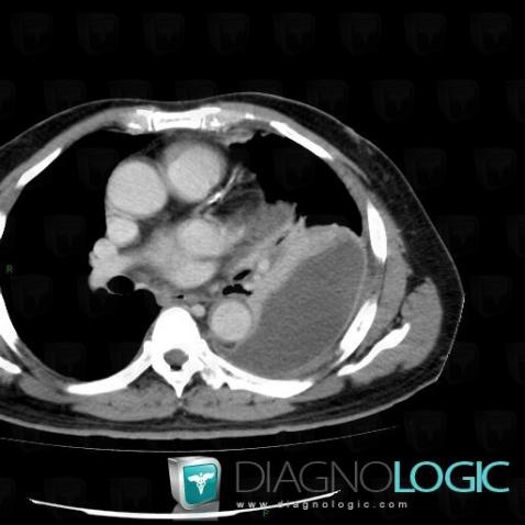 Empyema, Pleura, CT