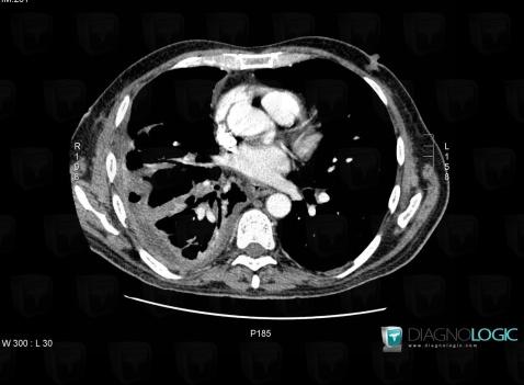 Empyema, Pleura, CT