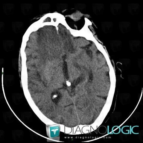 Encephalitis, Cerebral hemispheres, CT