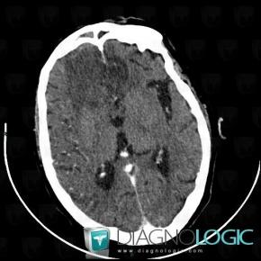 Encephalitis, Cerebral hemispheres, CT