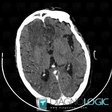 Encephalitis, Cerebral hemispheres, CT