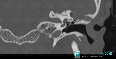Encephalocele, Cerebral hemispheres, CT