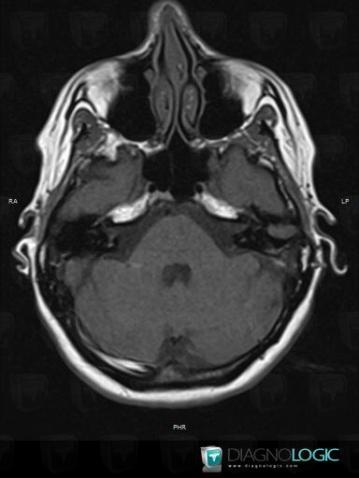 Encephalocele, Cerebral hemispheres, MRI