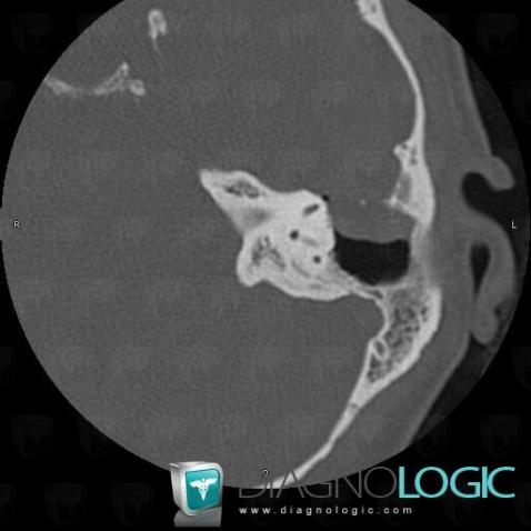 Encephalocele, Middle ear, CT