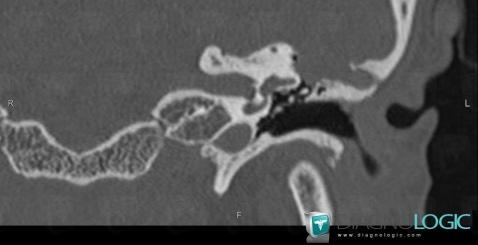Encephalocele, Temporal bone, CT