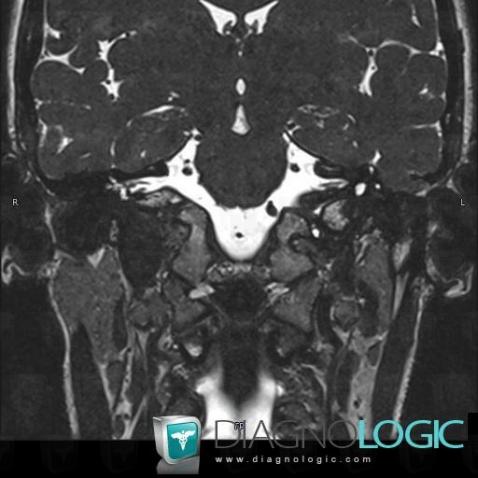 Encephalocele, Temporal bone, Middle ear, MRI