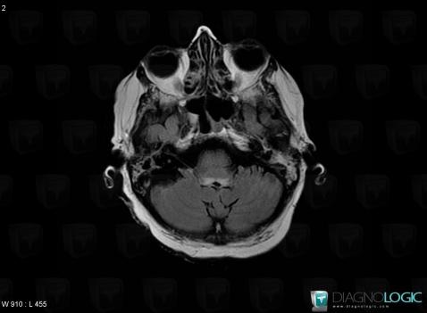 Encéphalopathie-Gayet Wernicke, Tronc cérébral, V4 et vermis, IRM