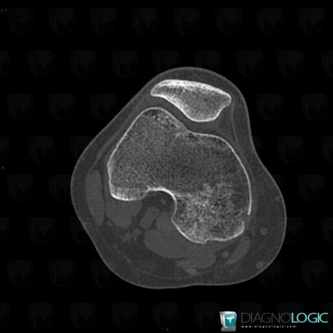 Enchondroma, Femur - Distal part, CT