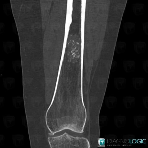 Enchondroma, Femur - Distal part, CT