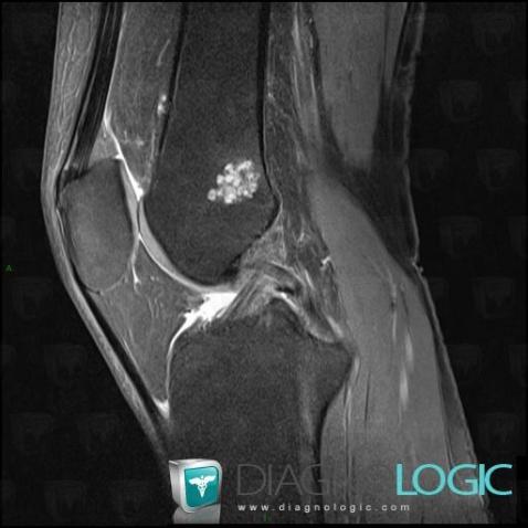 Enchondroma, Femur - Distal part, MRI