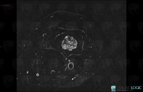 Enchondroma, Femur - Distal part, MRI