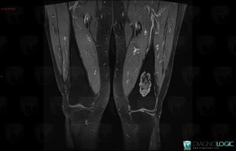 Enchondroma, Femur - Distal part, MRI