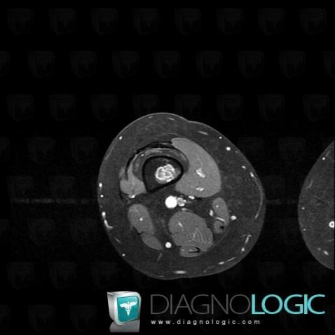 Enchondroma, Femur - Distal part, MRI