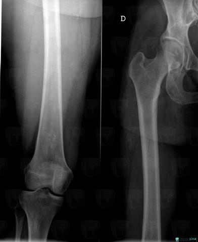 Enchondroma, Femur - Distal part, X rays