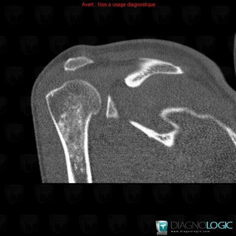 Enchondroma, Humerus - Proximal part, CT