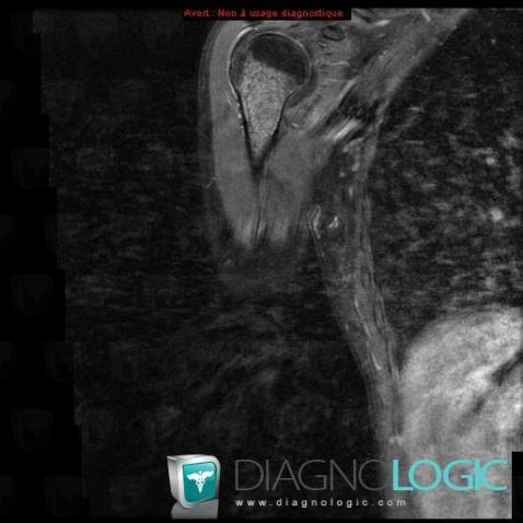 Enchondroma, Humerus - Proximal part, MRI