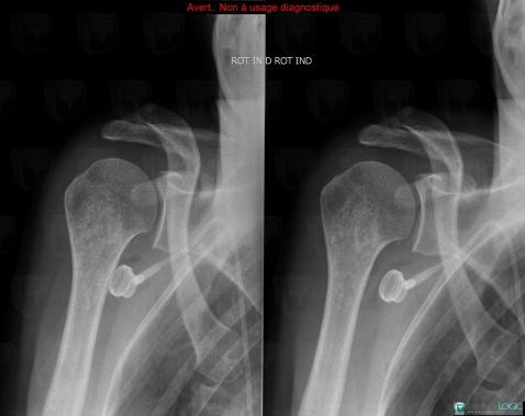 Enchondroma, Humerus - Proximal part, X rays