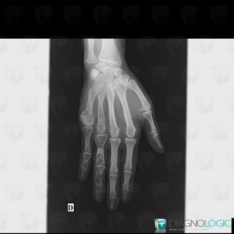 Enchondroma, Metacarpal bones, Phalanx / Sesamoid bones - Hand, X rays