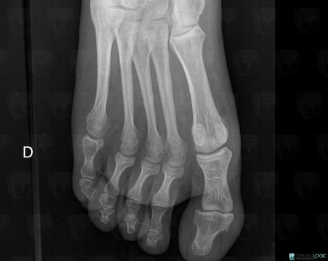 Enchondroma, Phalanx / Sesamoid bones - Foot, X rays